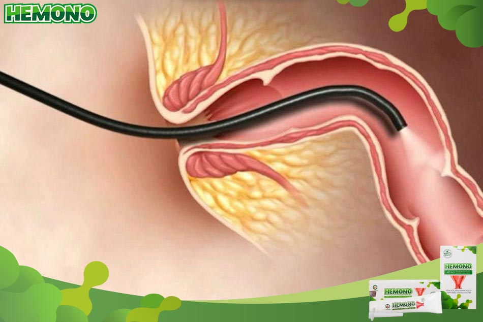 Những trường hợp nào cần nội soi trực tràng?