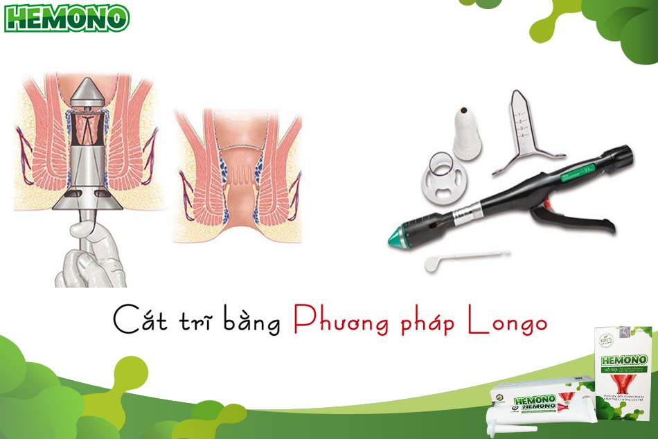 Cắt trĩ bằng phương pháp Longo