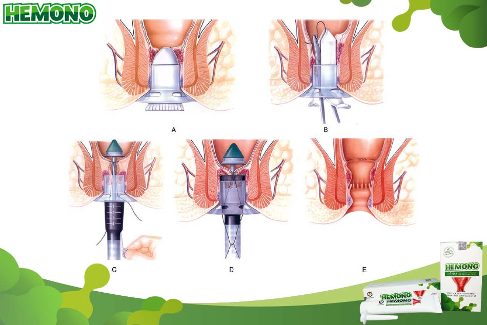 Các bước tiến hành phẫu thuật Longo