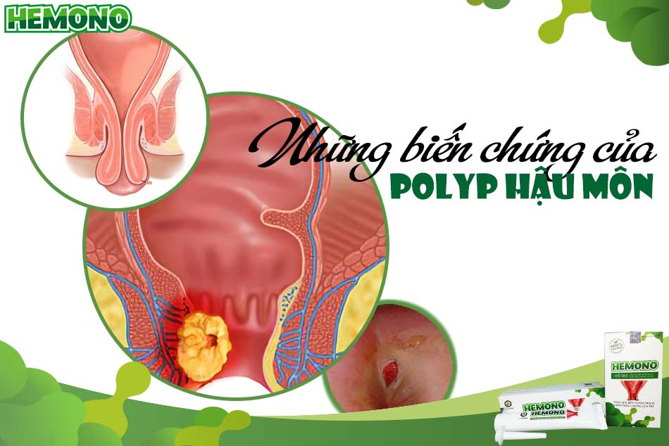Những biến chứng nguy hiểm của Polyp hậu môn