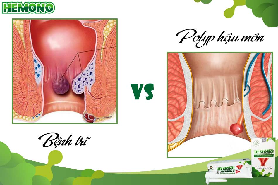 Phân biệt polyp hậu môn và trĩ