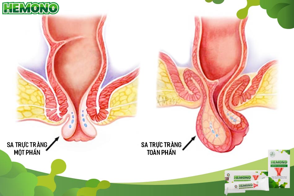 Sa trực tràng một phần và sa trực tràng toàn phần