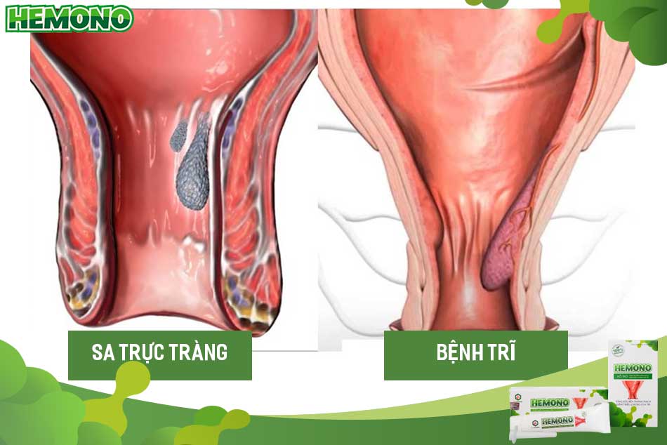 Phân biệt sa trực tràng với bệnh trĩ