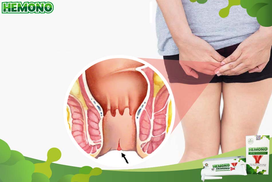 Đau hậu môn do nứt kẽ hậu môn