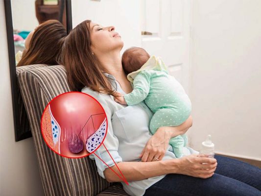 Bệnh trĩ sau sinh