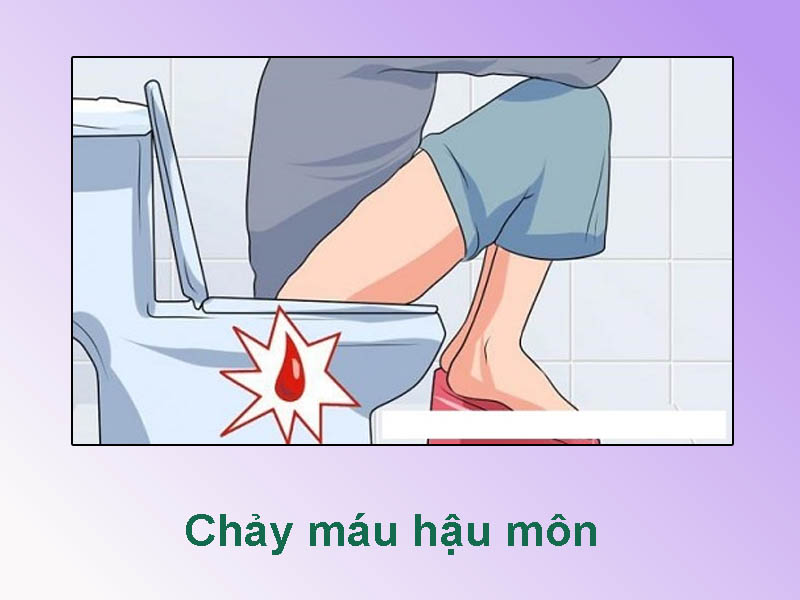 Chảy máu hậu môn do bị trĩ
