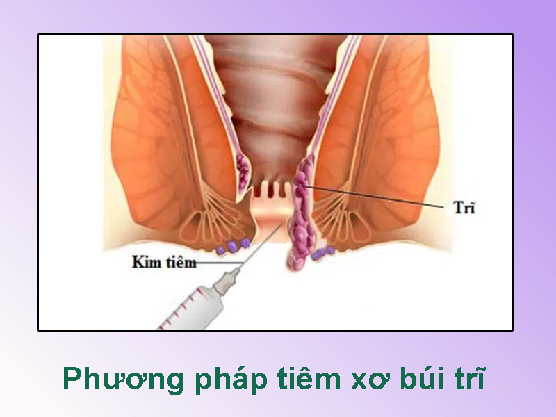 Chữa trĩ bằng phương pháp tiêm xơ búi trĩ