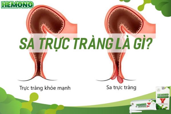 Sa trực tràng là gì, có phải là trĩ không? Nguyên nhân, cách điều trị