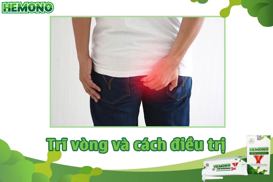 Trĩ vòng và cách điều trị