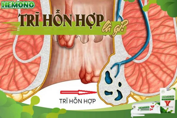 Trĩ hỗn hợp là gì?