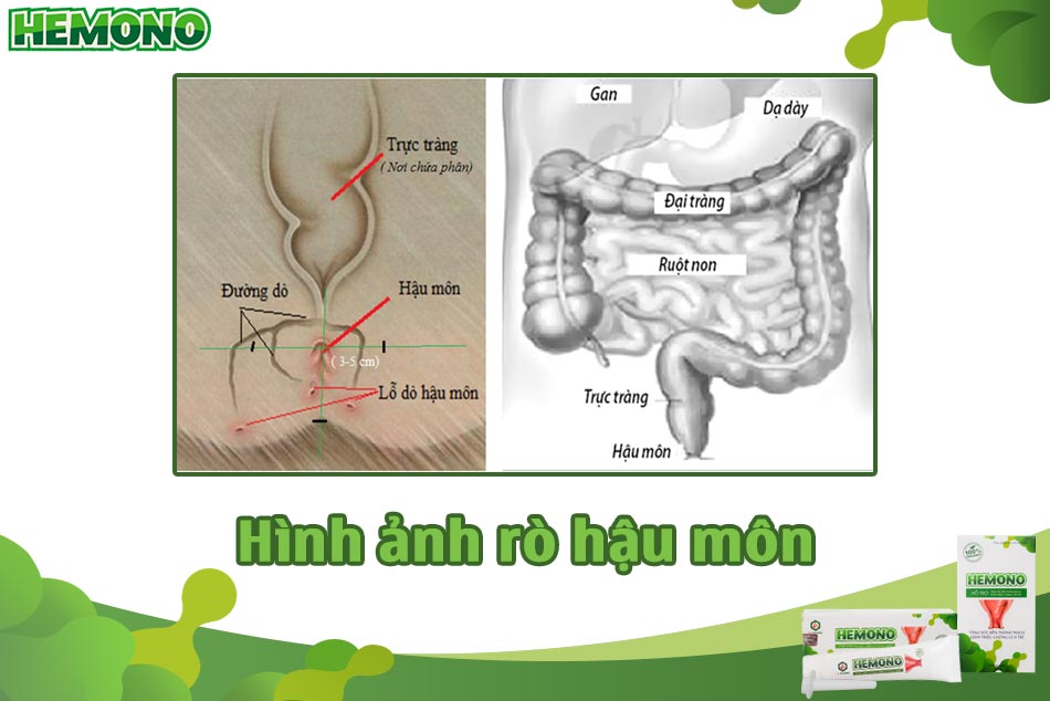 Rò hậu môn ở trẻ sơ sinh: Nguyên nhân, Biểu hiện, Cách điều trị