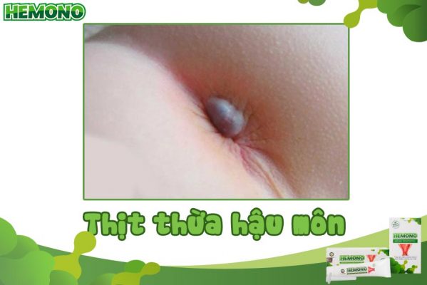 Thịt thừa hậu môn