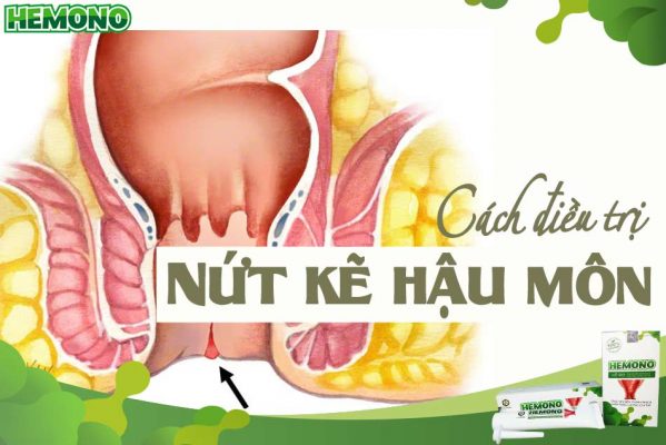 Nứt kẽ hậu môn là gì?