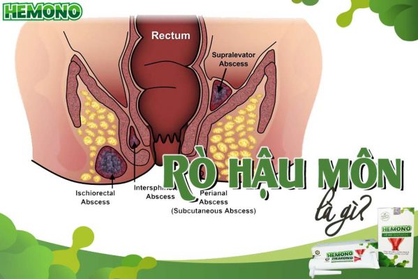 Rò hậu môn là gì?