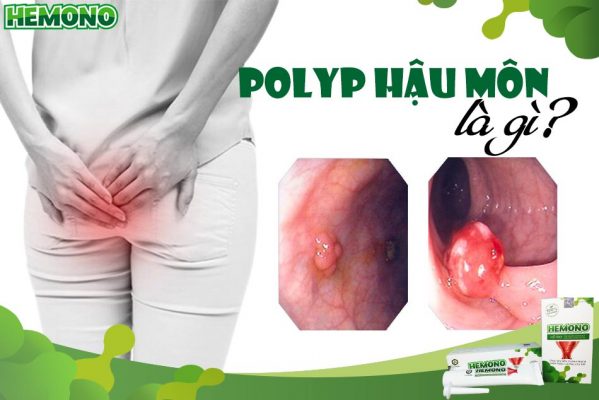 Polyp hậu môn